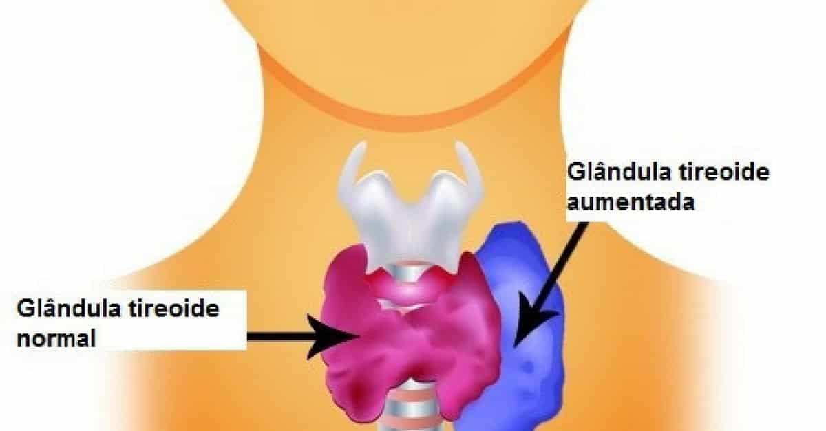 O Que Hipertireoidismo Os Sintomas E Tratamentos
