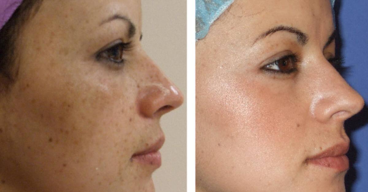 Brown facial spot treatment