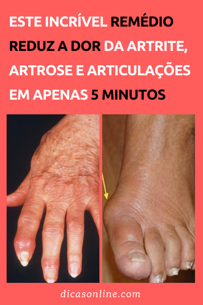 Receita Simples Para Tratar A Artrose