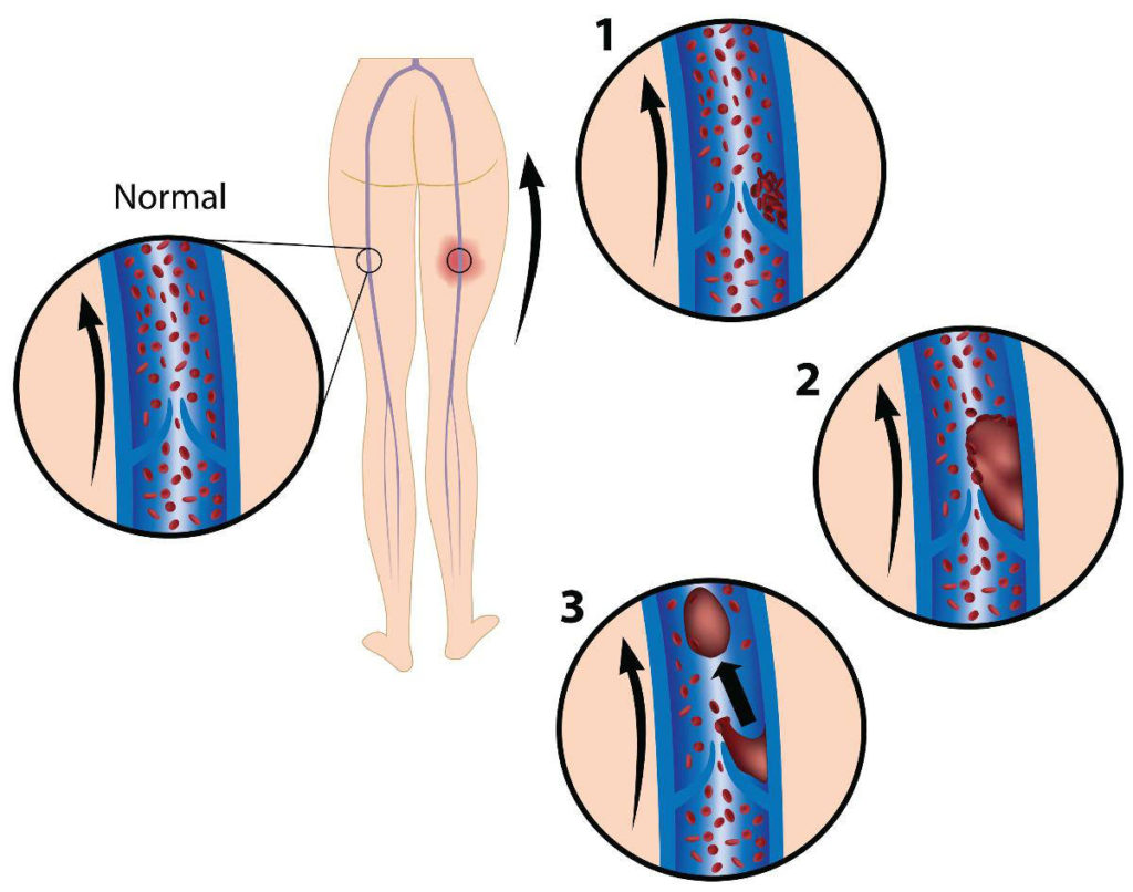 Sintomas Da Trombose