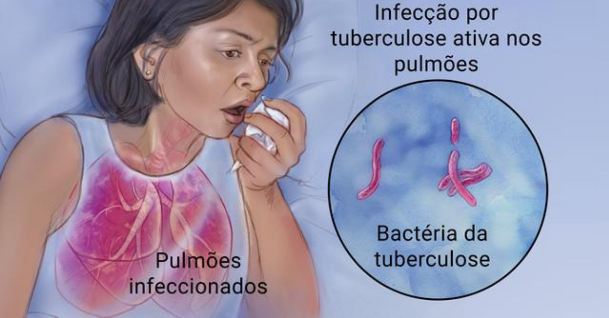 Tuberculose Mata Quase Mil Pessoas Todos Os Dias