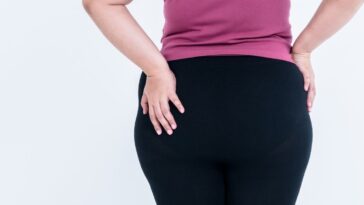 o que é lipedema