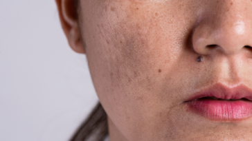 Dúvidas mais frequentes de quem sofre com melasma