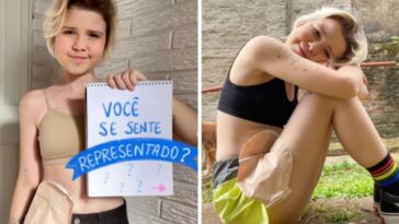 Influencer conta como conseguiu se aceitar com bolsa de colostomia