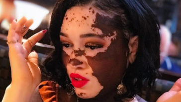 Modelo com vitiligo revela ter sofrido racismo