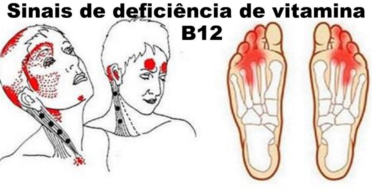 Falta De Vitamina B12 10 Sintomas Causas E Como Prevenir 5715