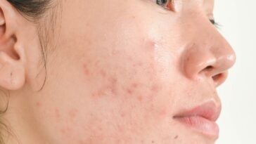 acne adulta como tratar