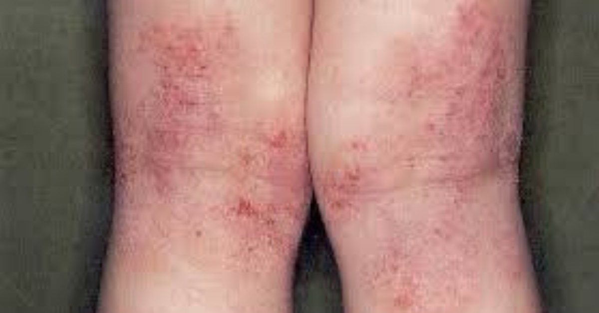 O que é e como tratar a dermatite atópica
