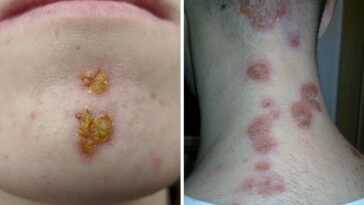 impetigo tratamentos