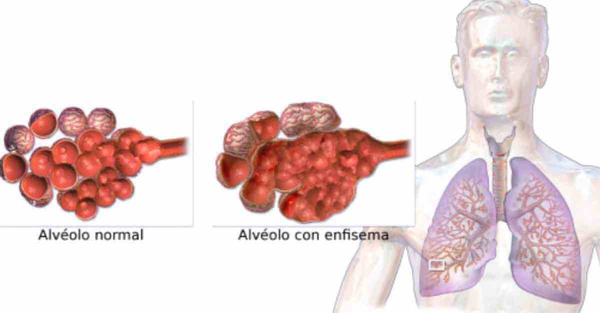 alivie-os-sintomas-da-enfisema-pulmonar-com-estas-dicas