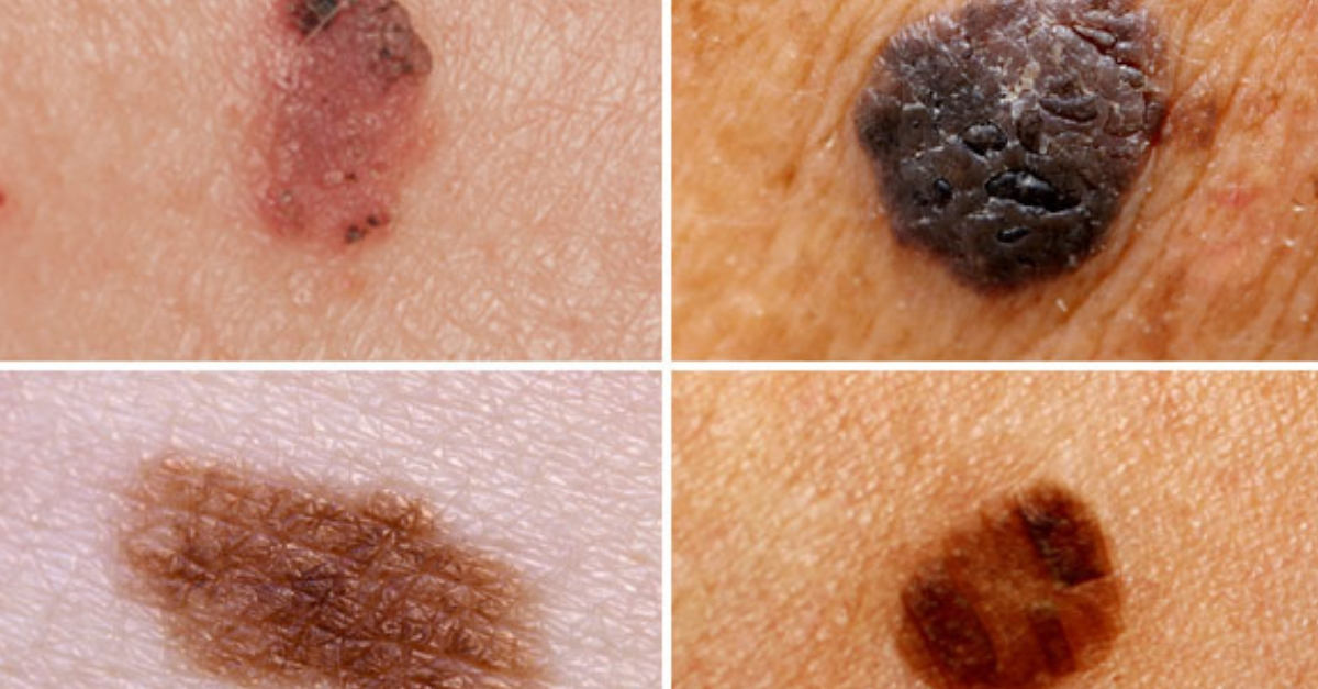 Como identificar um melanoma