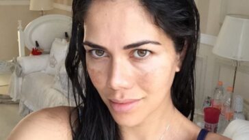 melasma daniela albuquerque