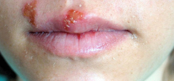 herpes-simples-o-que-causas-e-tratamento