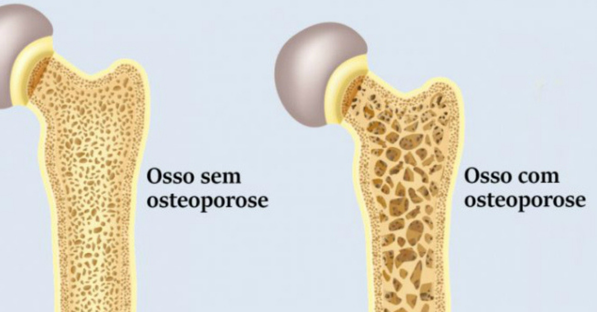 O Que Significa Osteoporose EDUKITA