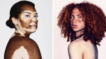 pessoas com sardas e vitiligo