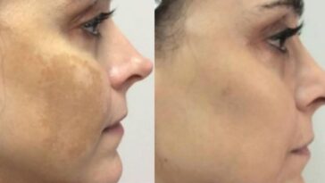 tratamento para melasma da atriz alexandra martins